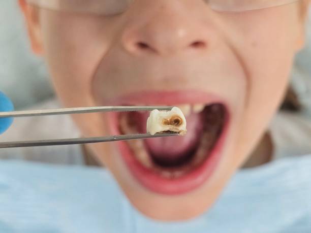 Best Emergency Wisdom Teeth Removal in Bergenfield, NJ